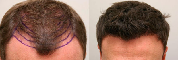 Before and After Photos of Hair Transplant Photo hair transplant strip technique 002