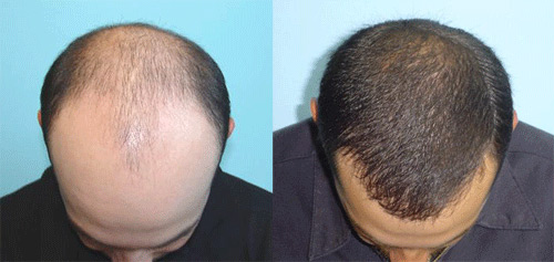 Before and After Photos of Hair Transplant Photo hair transplant strip technique
