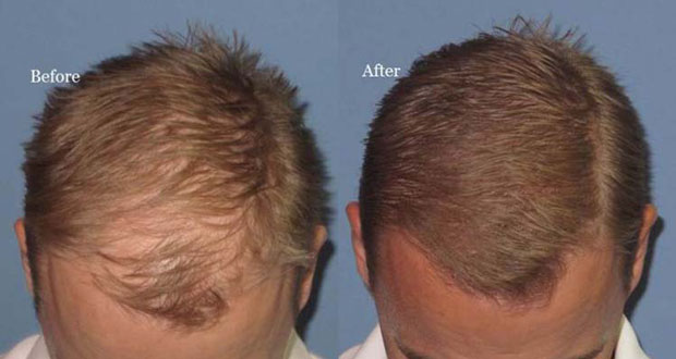 Before and After Photos of Hair Transplant Technique fue 001