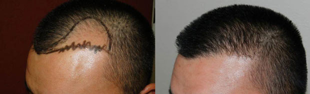 Before and After Photos of Hair Transplant Technique fue 002