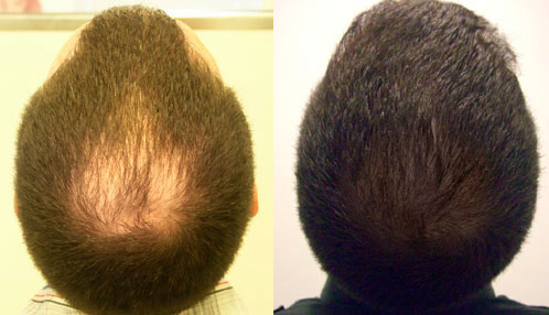 Before and After Photos of Hair Transplant Technique fue 004