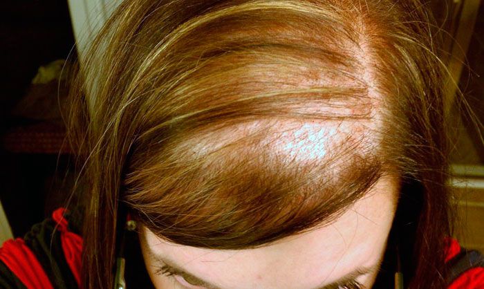 Resolve your doubts about diffuse alopecia female diffuse alopecia