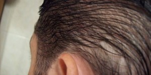 Resolve your doubts about diffuse alopecia male diffuse alopecia