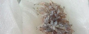 Hair Transplant FUE with Automated Technique FUE hair graft