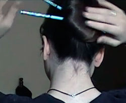 What is traction alopecia, treatment, causes, and symptoms pencil in hair