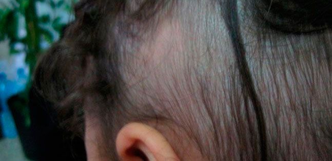 Do you know the types of hair loss or why it falls out? hair loss due to telogen effluvium