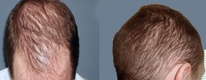 Diffuse alopecia: Do you doubt the treatment? What about the diagnosis? Treatment for diffuse alopecia doubts