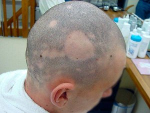 Alopecia areata, treatment, causes, cure, and types alopecia areata