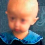 alopecia infantil genetica