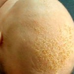 Alopecia infantil por hongos
