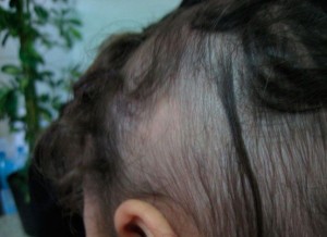 chica con alopecia de efluvio telogeno