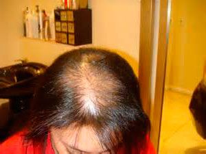 mujer con alopecia difusa