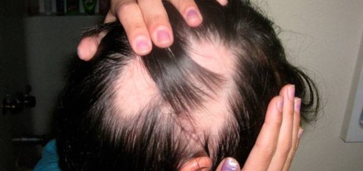 alopecia areata mujeres