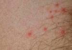 foliculitis bacteriana